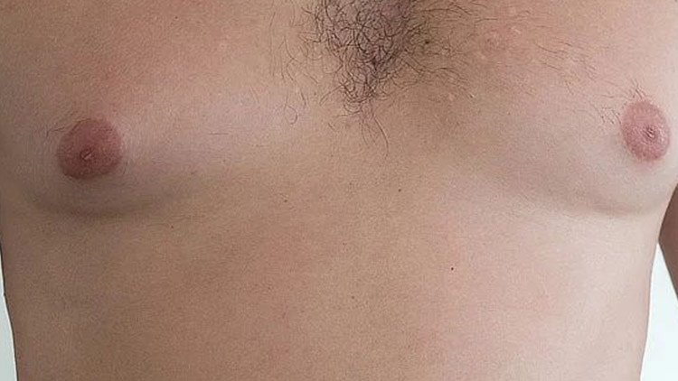 „Narostla mi ženská prsa,  musel jsem dvakrát na operaci“