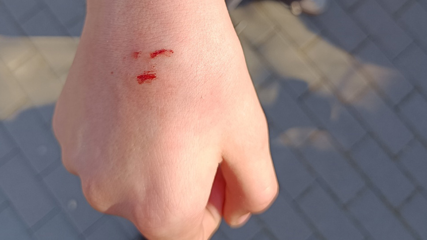 Pes pokousal malého chlapce!