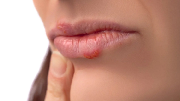 Opar na rtu zastavte co nejdřív