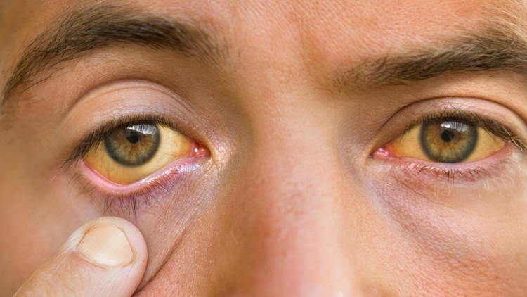 Žloutenka řádí v celé republice